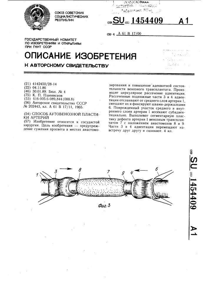 Способ аутовенозной пластики артерий (патент 1454409)