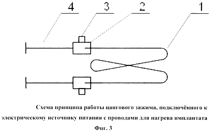 Устройство электронагрева имплантата при наложении анастомозов полых органов желудочно-кишечного тракта (патент 2567274)