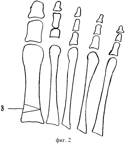 Способ оперативного лечения вальгусного отклонения первого пальца стопы ii-iv степени и молоткообразной деформации второго пальца (патент 2257174)