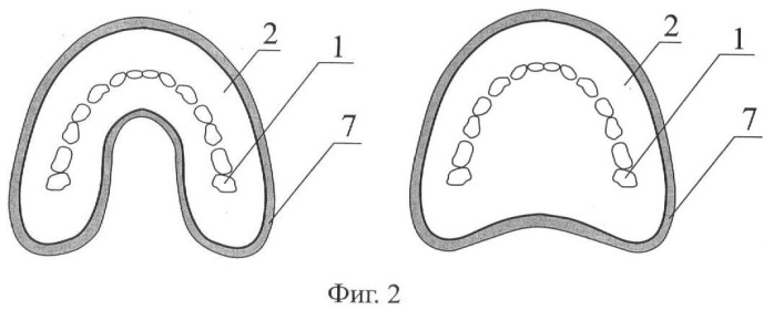 Съемный протез на беззубую нижнюю и верхнюю челюсти куретовых (4 варианта) (патент 2387406)