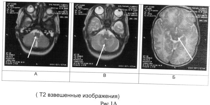 Способ определения зрелости церебральных структур у недоношенных новорожденных (патент 2491888)