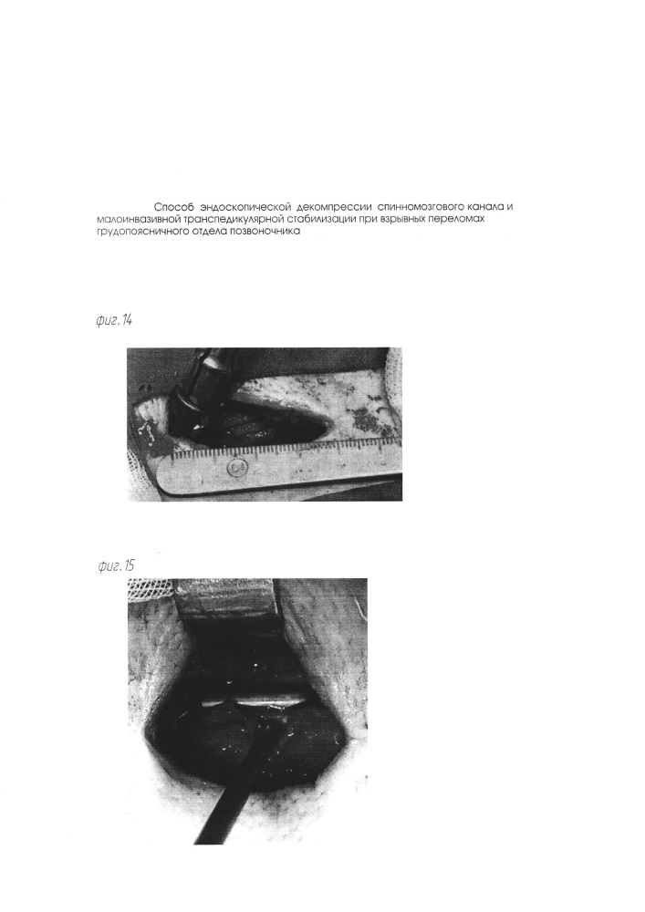 Способ эндоскопической декомпрессии спинномозгового канала и малоинвазивной транспедикулярной стабилизации при взрывных переломах грудопоясничного отдела позвоночника (патент 2649826)