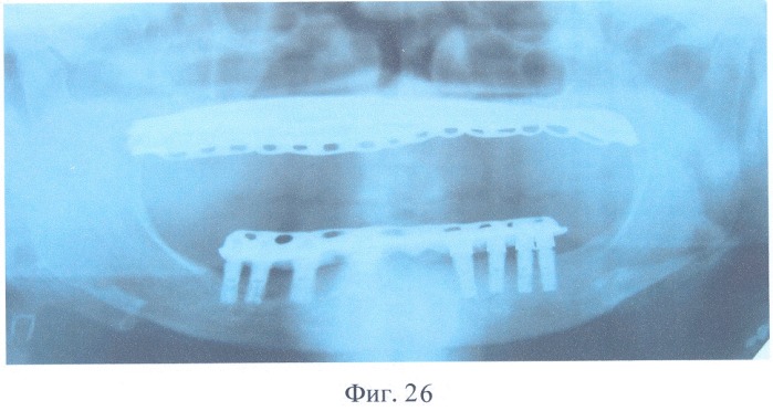 Зубной протез с опорой на внутрикостные имплантаты (патент 2326621)