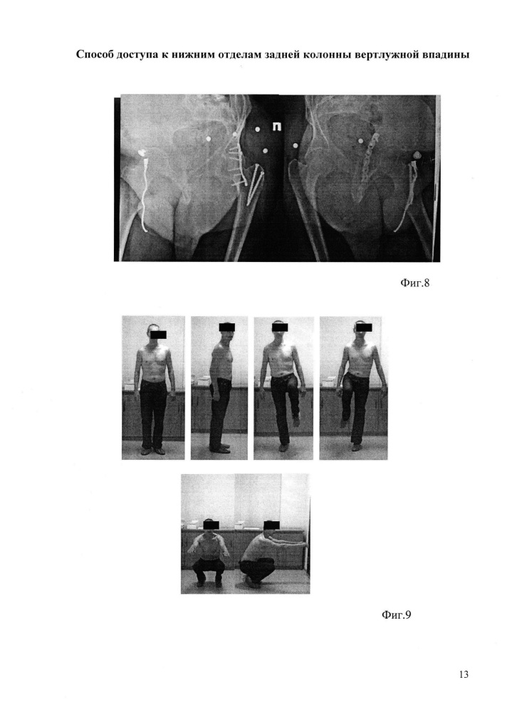 Способ доступа к нижним отделам задней колонны вертлужной впадины (патент 2624387)