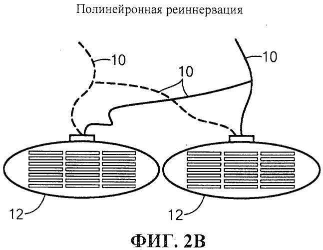 Система и способ стимуляции лицевого нерва (патент 2511082)