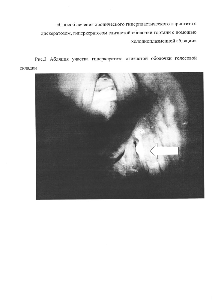 Способ лечения хронического гиперпластического ларингита с дискератозом, гиперкератозом слизистой оболочки гортани с помощью холодноплазменной абляции (патент 2658479)