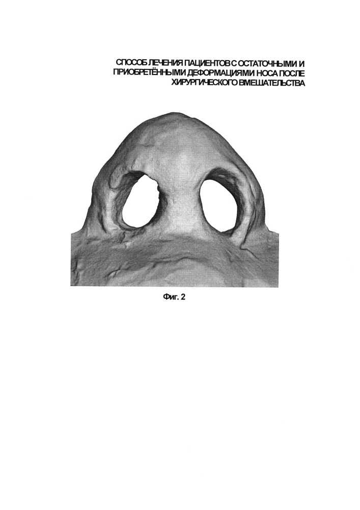 Способ лечения пациентов после хирургического вмешательства, выполненного по поводу остаточных и приобретённых деформаций носа (патент 2630130)