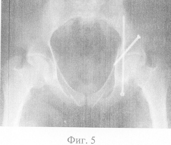 Способ закрытого остеосинтеза переломов вертлужной впадины (патент 2327427)