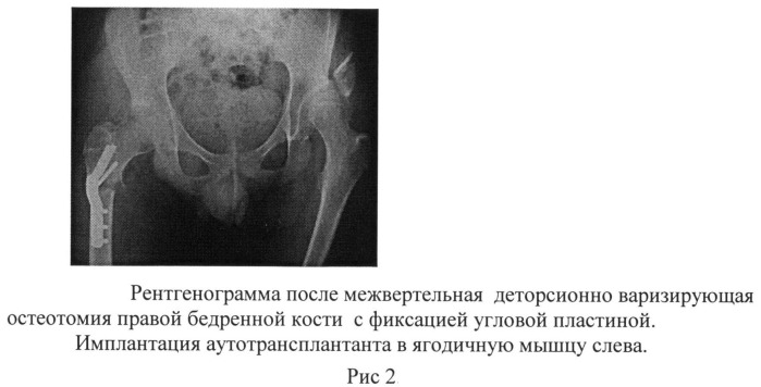 Способ остеотомии таза при лечении дисплазии вертлужной впадины у детей с дцп (патент 2501532)