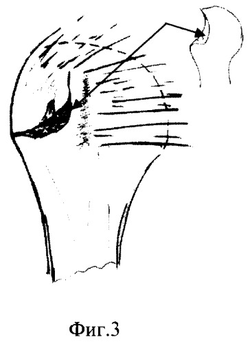 Способ пластики импрессионных дефектов головки плечевой кости (патент 2290122)
