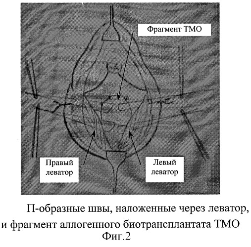 Способ хирургического лечения ректоцеле (патент 2283038)