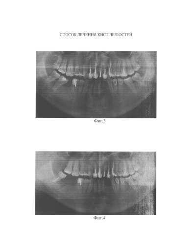 Способ лечения кист челюстей (патент 2578161)