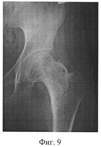 Способ лечения деформаций проксимального отдела бедра (патент 2528964)