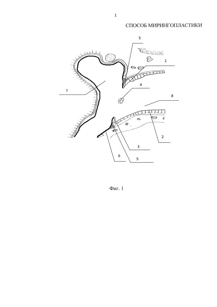 Способ мирингопластики (патент 2649303)