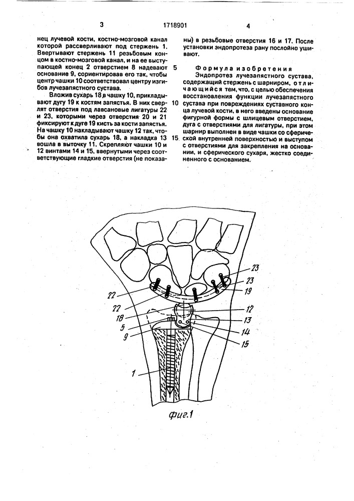 Эндопротез лучезапястного сустава системы а.и.шаповала, в.п.лукина и г.в.валенцева (патент 1718901)