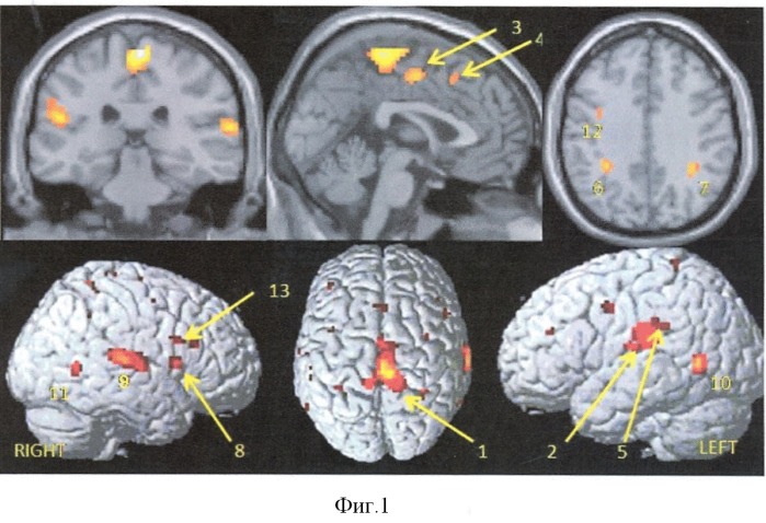Способ нейровизуализации зон активации головного мозга, ответственных за ходьбу (патент 2428931)