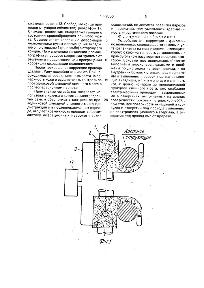 Устройство для коррекции и фиксации позвоночника (патент 1779356)
