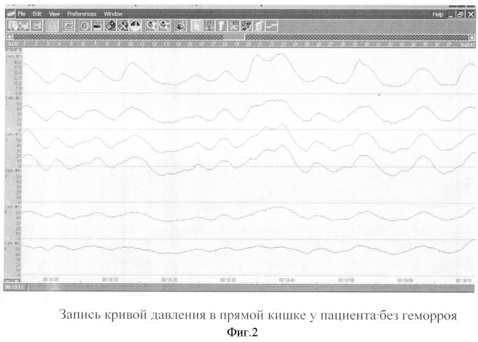 Способ ранней диагностики геморроя (патент 2341187)