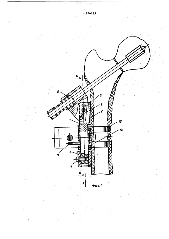 Устройство для направленного введения стержня при остеосинтезе переломов шейки бедра (патент 876125)