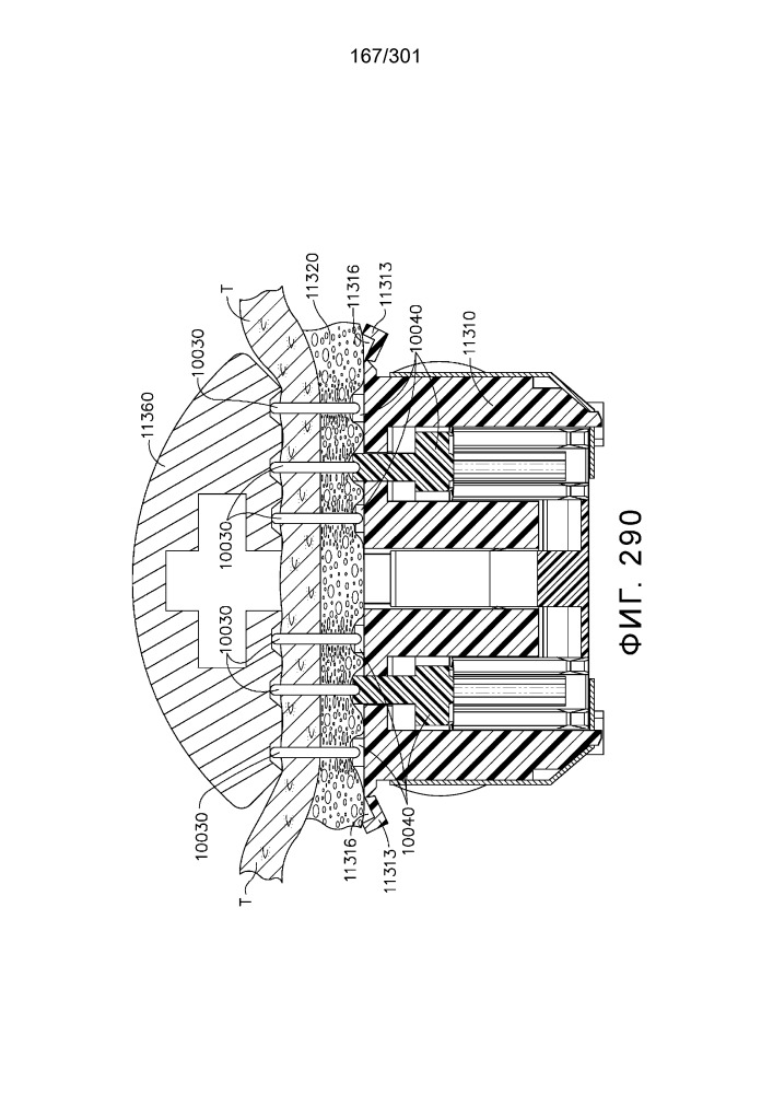 Компенсатор толщины ткани, содержащий резервуар (патент 2661012)