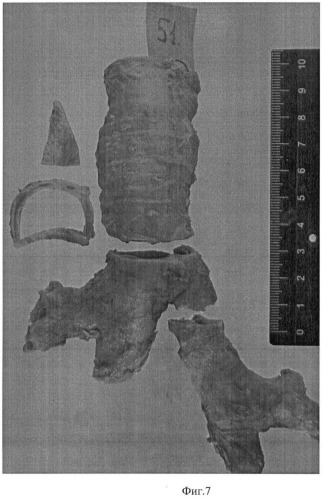 Способ приведения в соответствие периметров сечения трахеи и левого главного бронха при наложении трахеобронхиального анастомоза (патент 2467701)