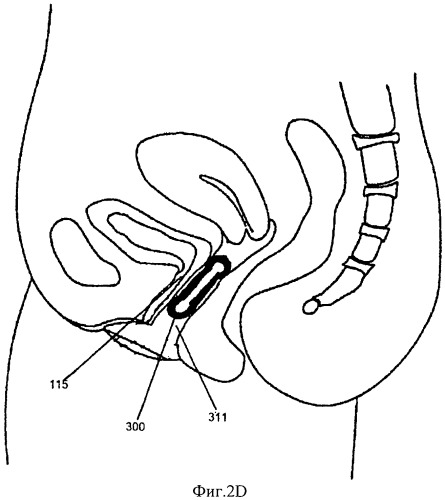 Пессарии для уменьшения пролапса (патент 2512811)