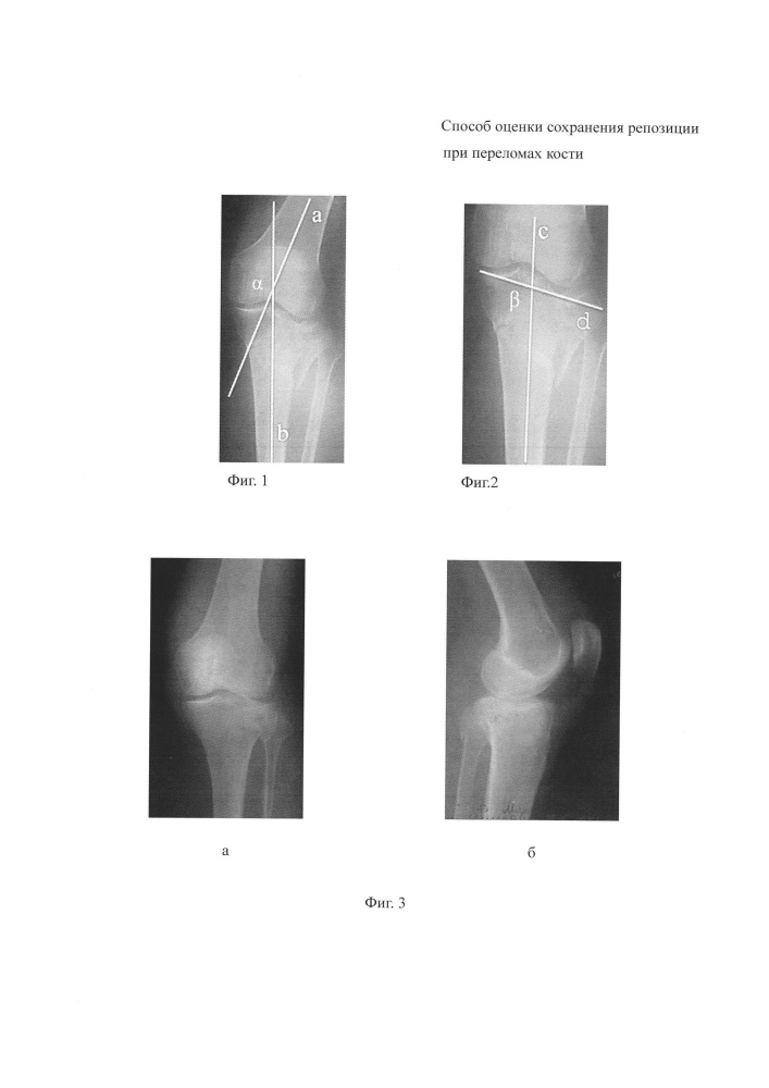 Способ оценки сохранения репозиции переломов костей (патент 2626375)