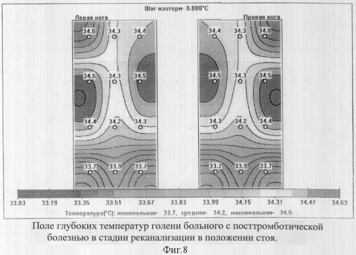 Способ комбинированной термометрии для диагностики посттромботической болезни вен нижних конечностей (патент 2319438)