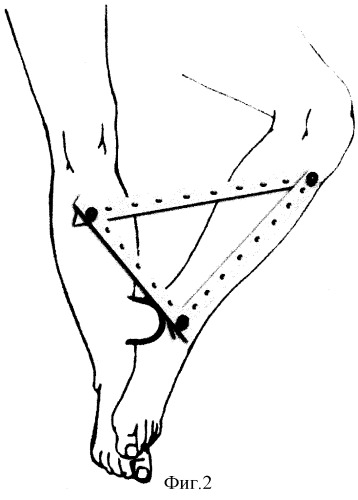 Способ фиксации нижних конечностей между собой при перемещении комплексов тканей на временной питающей ножке (патент 2306876)