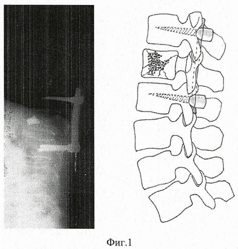 Способ пластики тела сломанного позвонка (патент 2411017)
