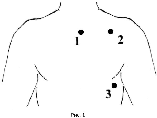 Способ выбора точек для аппроксимированных отведений электрокардиограммы (патент 2571709)