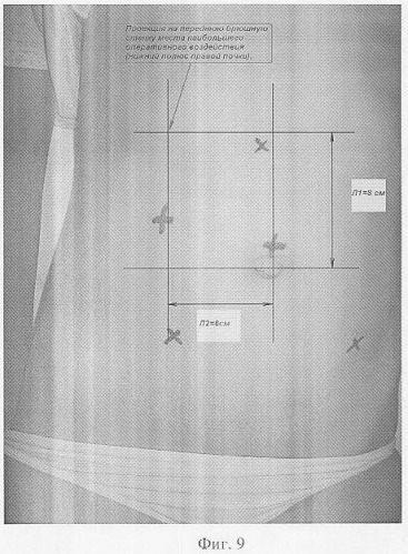 Способ определения мест оптимальной установки манипуляционных троакаров при лапароскопических операциях на органах забрюшинного пространства (патент 2338481)