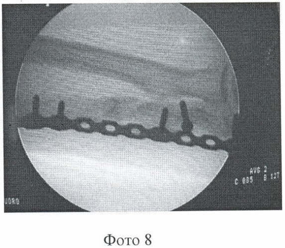 Способ лечения несросшихся переломов и ложных суставов длинных костей (патент 2359632)
