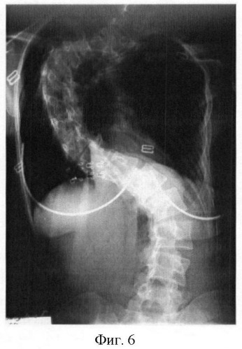 Способ лечения идиопатического сколиоза (патент 2434599)