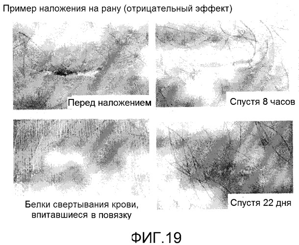 Повязка для лечения кожных заболеваний и облегчения симптомов кожных болезней, вызывающих экссудацию белков крови (патент 2524628)