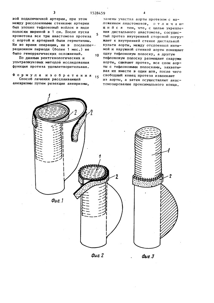 Способ лечения расслаивающей аневризмы (патент 1528459)