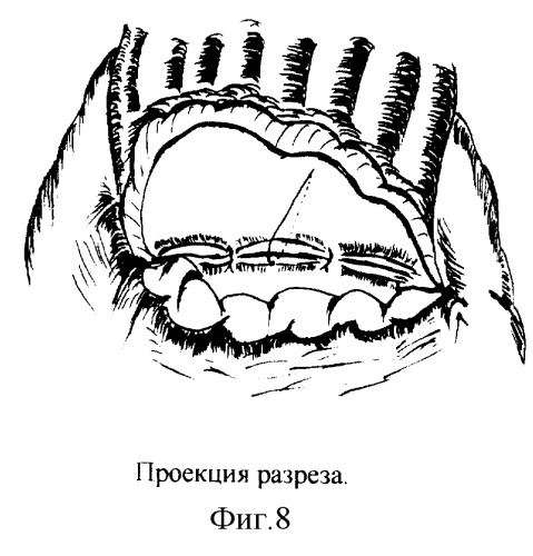 Новый способ формирования эзофагогастроанастомоза в условиях недостатка пластического материала путем модификации задней губы (патент 2248185)