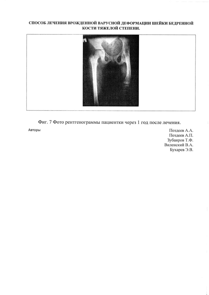 Способ лечения врожденной варусной деформации шейки бедренной кости тяжелой степени (патент 2635441)