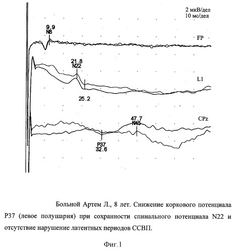 Способ оценки тяжести инфекционного поражения цнс у детей (патент 2295281)