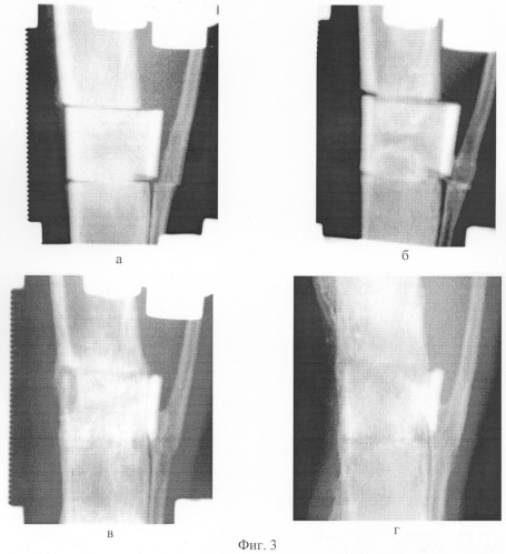 Способ моделирования замещения дефекта длинной трубчатой кости (патент 2281050)