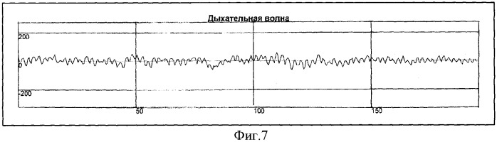 Способ определения типа демпинг-реакции при демпинг-синдроме (патент 2334456)