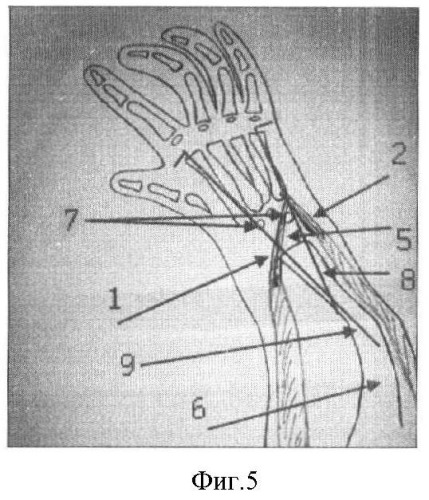 Способ лечения врожденной лучевой косорукости (патент 2372863)