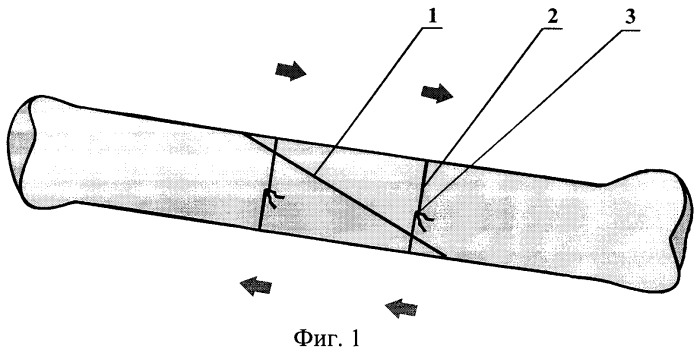 Способ фиксации отломков трубчатых костей с косыми и винтообразными переломами (патент 2331379)