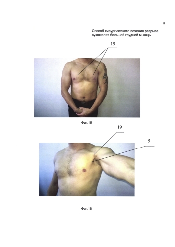 Способ хирургического лечения застарелого разрыва сухожилия большой грудной мышцы (патент 2585412)