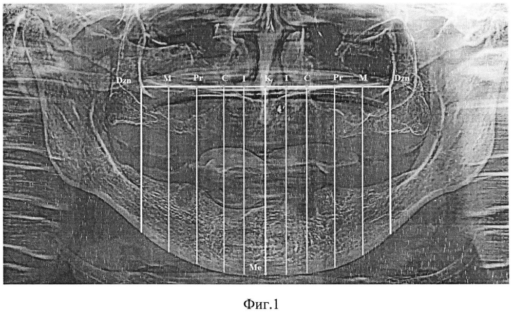 Способ определения позиции дентальных имплантатов на этапах реабилитации пациента с отсутствием зубов (патент 2665141)
