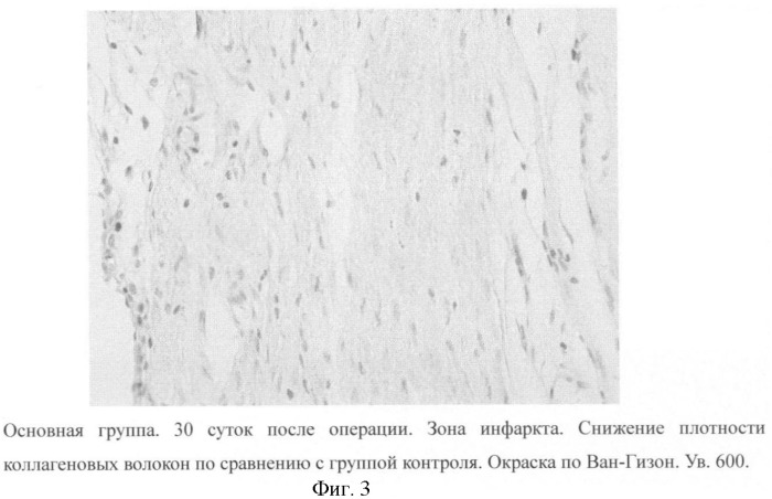 Способ коррекции плотности соединительной ткани (патент 2392960)