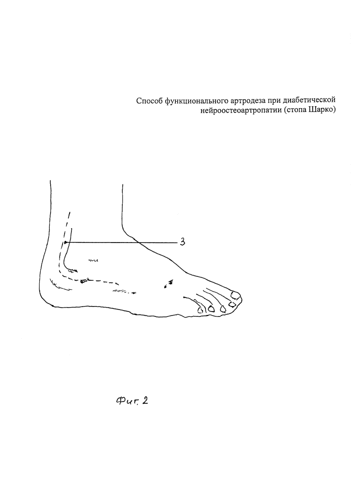 Способ функционального артродеза при диабетической нейроостеоартропатии (стопа шарко) (патент 2604383)