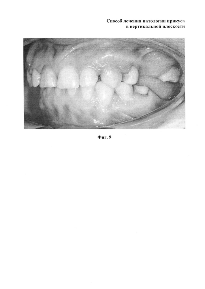 Способ лечения патологии прикуса в вертикальной плоскости (патент 2617181)