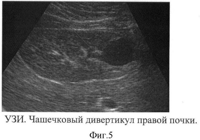 Способ дифференциальной диагностики чашечковых дивертикулов и солитарных кист почек у детей (патент 2411910)