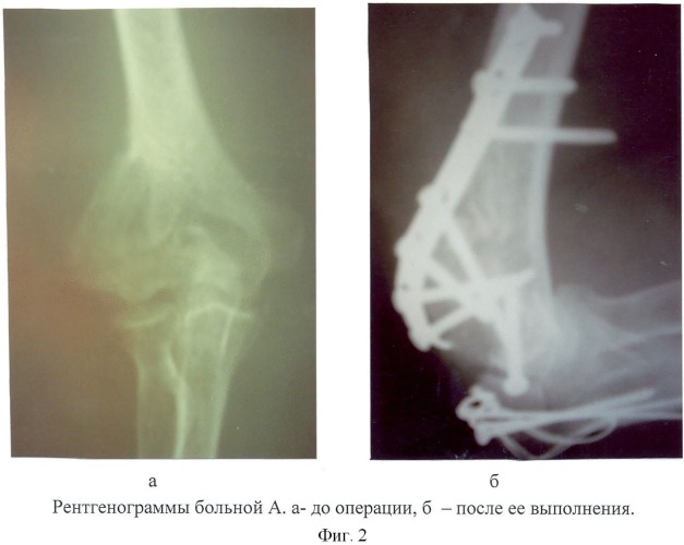 Способ лечения переломов мыщелков плеча (патент 2466693)